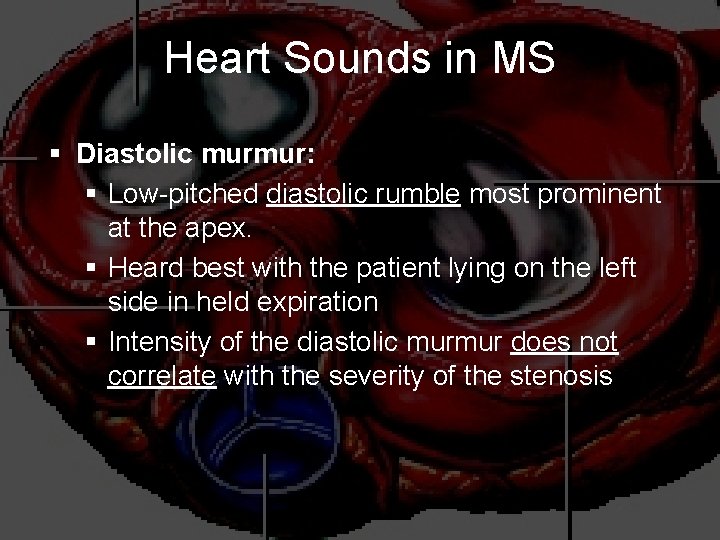 Heart Sounds in MS § Diastolic murmur: § Low-pitched diastolic rumble most prominent at