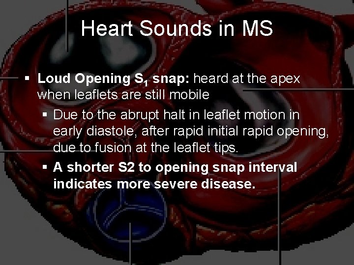 Heart Sounds in MS § Loud Opening S 1 snap: heard at the apex