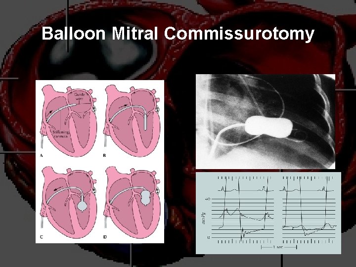 Balloon Mitral Commissurotomy 