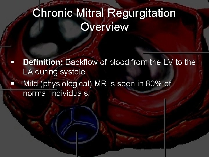Chronic Mitral Regurgitation Overview § § Definition: Backflow of blood from the LV to