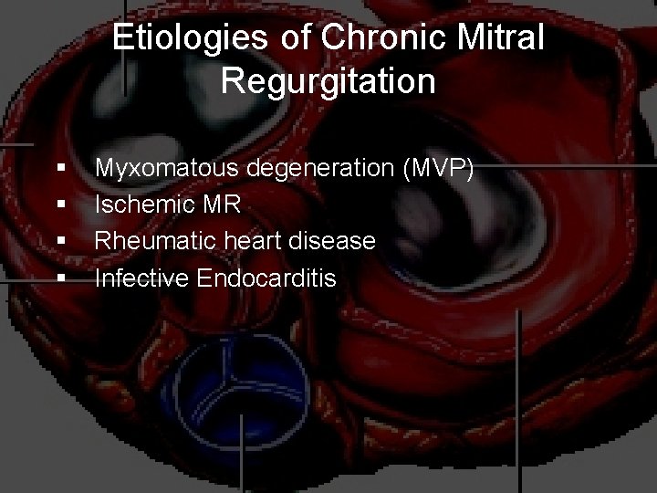Etiologies of Chronic Mitral Regurgitation § § Myxomatous degeneration (MVP) Ischemic MR Rheumatic heart