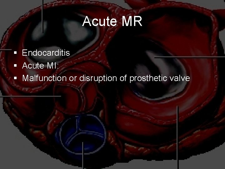 Acute MR § Endocarditis § Acute MI: § Malfunction or disruption of prosthetic valve