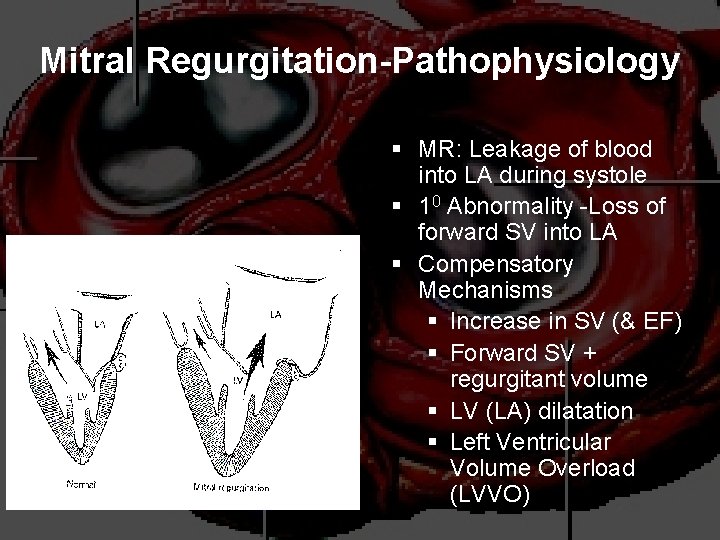 Mitral Regurgitation-Pathophysiology § MR: Leakage of blood into LA during systole § 10 Abnormality