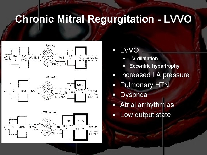Chronic Mitral Regurgitation - LVVO § LV dilatation § Eccentric hypertrophy § § §