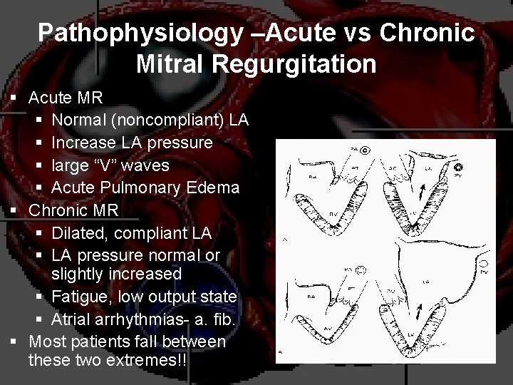 Pathophysiology –Acute vs Chronic Mitral Regurgitation § Acute MR § Normal (noncompliant) LA §