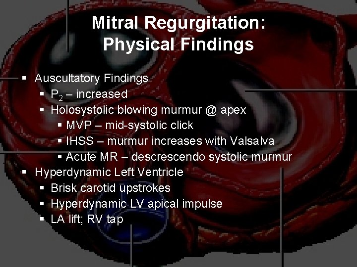 Mitral Regurgitation: Physical Findings § Auscultatory Findings § P 2 – increased § Holosystolic