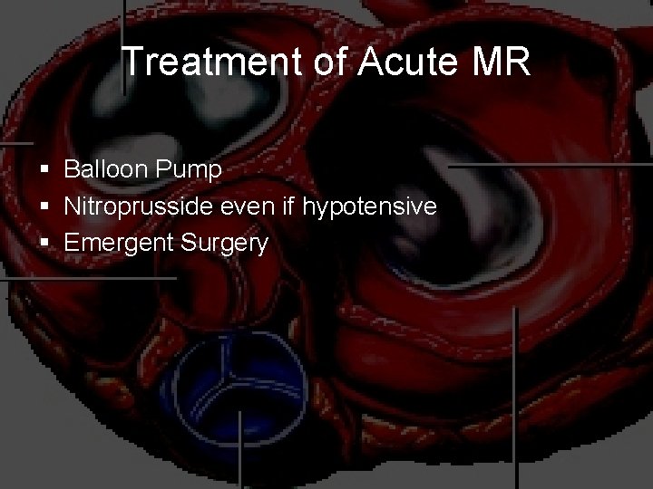 Treatment of Acute MR § Balloon Pump § Nitroprusside even if hypotensive § Emergent
