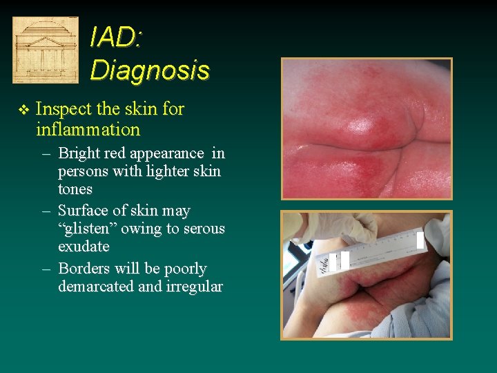 IAD: Diagnosis v Inspect the skin for inflammation – Bright red appearance in persons IAD: Diagnosis v Inspect the skin for inflammation – Bright red appearance in persons
