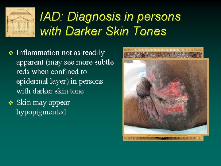 IAD: Diagnosis in persons with Darker Skin Tones v v Inflammation not as readily IAD: Diagnosis in persons with Darker Skin Tones v v Inflammation not as readily