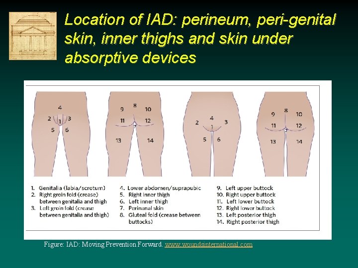 Location of IAD: perineum, peri-genital skin, inner thighs and skin under absorptive devices Figure: Location of IAD: perineum, peri-genital skin, inner thighs and skin under absorptive devices Figure: