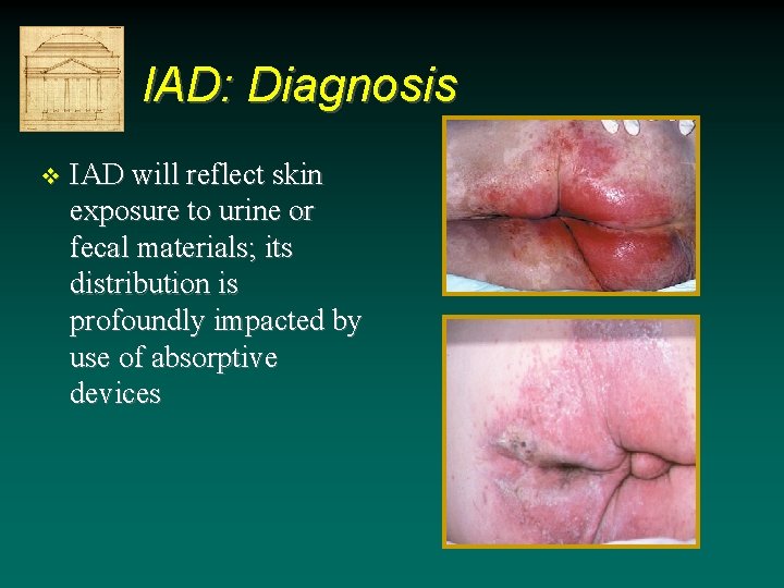 IAD: Diagnosis v IAD will reflect skin exposure to urine or fecal materials; its IAD: Diagnosis v IAD will reflect skin exposure to urine or fecal materials; its