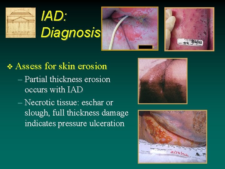IAD: Diagnosis v Assess for skin erosion – Partial thickness erosion occurs with IAD IAD: Diagnosis v Assess for skin erosion – Partial thickness erosion occurs with IAD