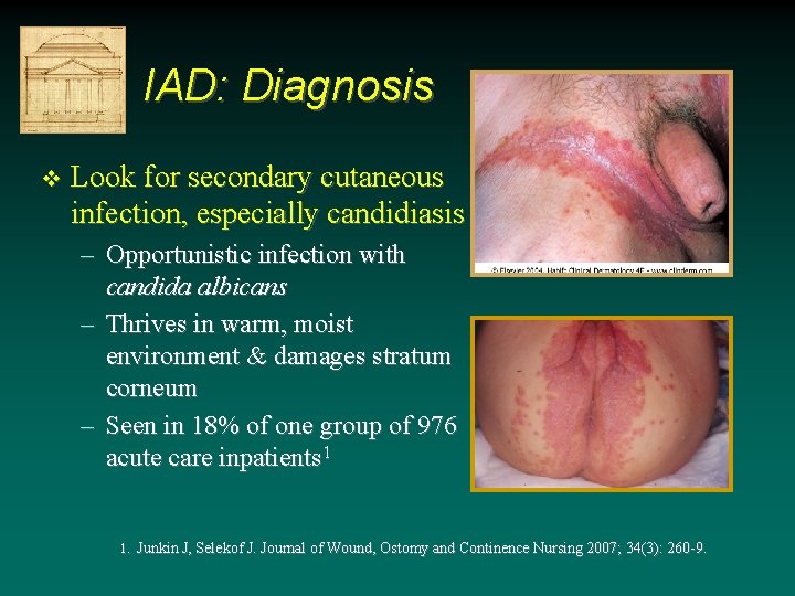 IAD: Diagnosis v Look for secondary cutaneous infection, especially candidiasis – Opportunistic infection with IAD: Diagnosis v Look for secondary cutaneous infection, especially candidiasis – Opportunistic infection with