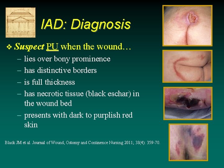 IAD: Diagnosis v Suspect PU when the wound… – – lies over bony prominence IAD: Diagnosis v Suspect PU when the wound… – – lies over bony prominence
