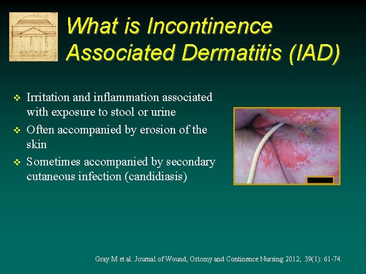 What is Incontinence Associated Dermatitis (IAD) v v v Irritation and inflammation associated with What is Incontinence Associated Dermatitis (IAD) v v v Irritation and inflammation associated with