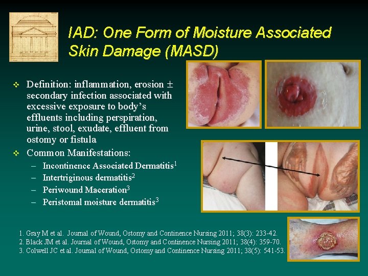 IAD: One Form of Moisture Associated Skin Damage (MASD) v v Definition: inflammation, erosion IAD: One Form of Moisture Associated Skin Damage (MASD) v v Definition: inflammation, erosion