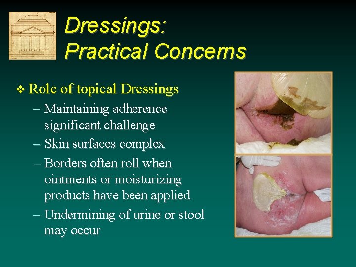 Dressings: Practical Concerns v Role of topical Dressings – Maintaining adherence significant challenge – Dressings: Practical Concerns v Role of topical Dressings – Maintaining adherence significant challenge –