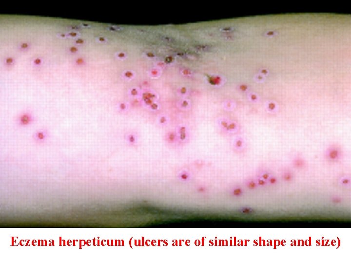 Eczema herpeticum (ulcers are of similar shape and size) ulcers 