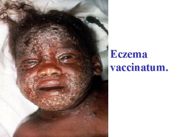 Eczema vaccinatum. 