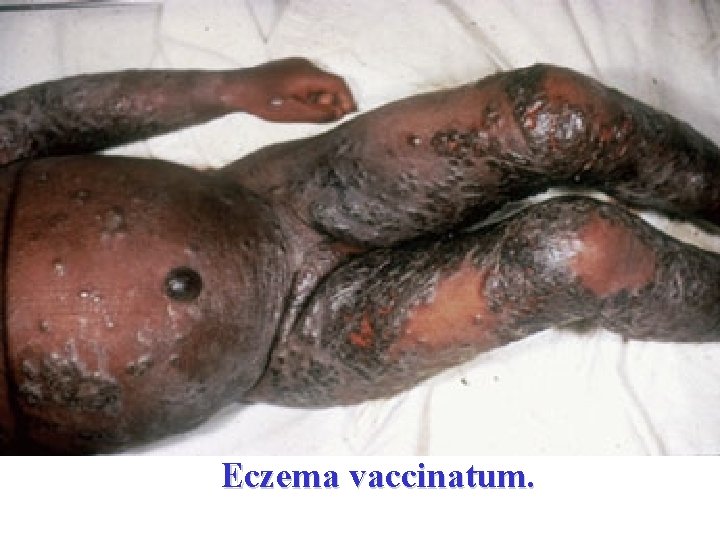 Eczema vaccinatum. 