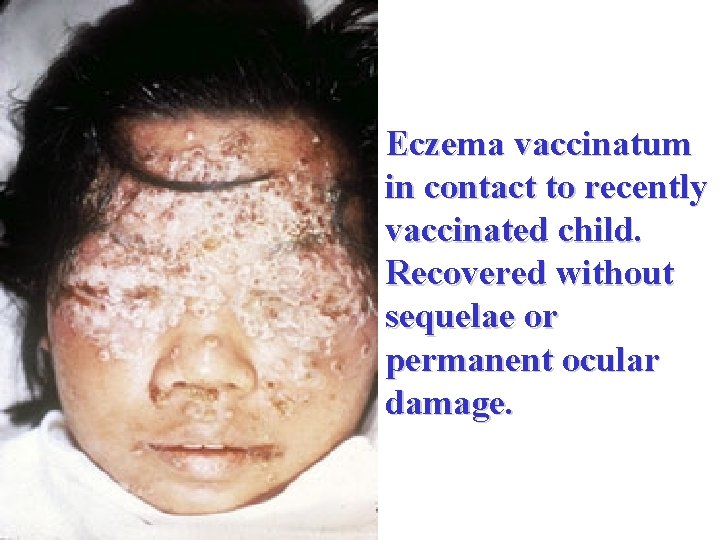 Eczema vaccinatum in contact to recently vaccinated child. Recovered without sequelae or permanent ocular
