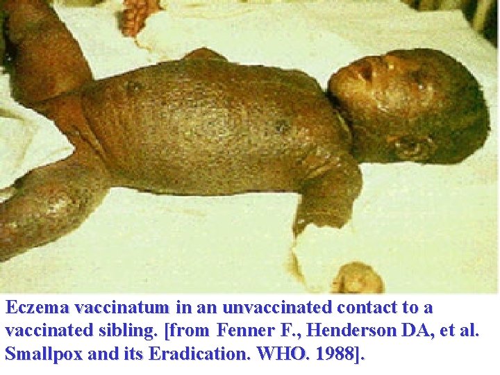 Eczema vaccinatum in an unvaccinated contact to a vaccinated sibling. [from Fenner F. ,