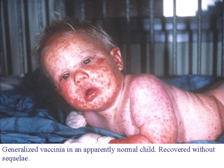 Generalized vaccinia in an apparently normal child. Recovered without sequelae. 