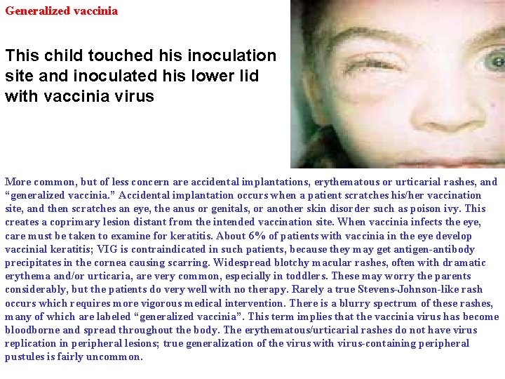 Generalized vaccinia This child touched his inoculation site and inoculated his lower lid with