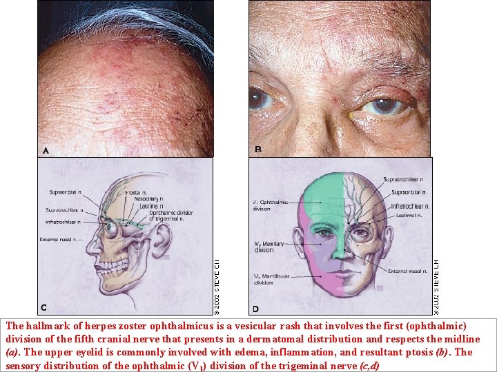 The hallmark of herpes zoster ophthalmicus is a vesicular rash that involves the first