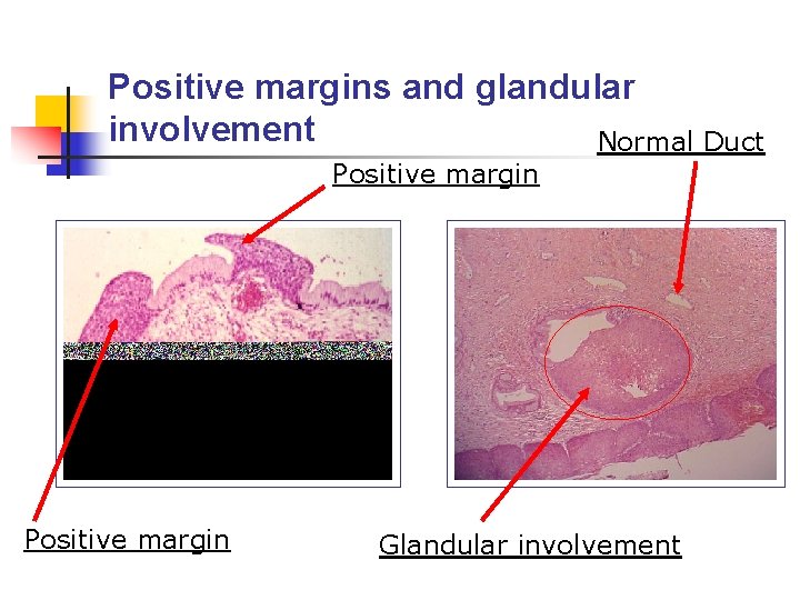 Positive margins and glandular involvement Normal Duct Positive margin Glandular involvement 