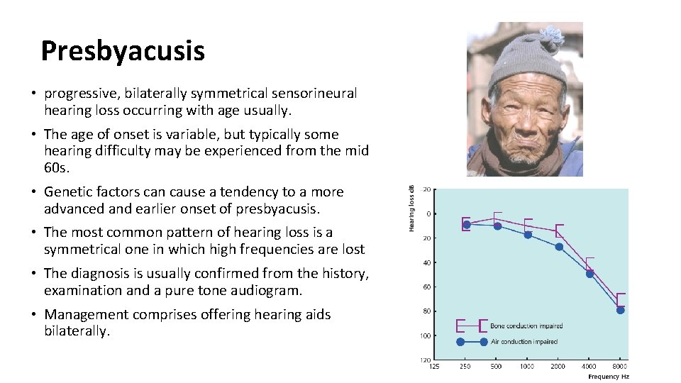 Presbyacusis • progressive, bilaterally symmetrical sensorineural hearing loss occurring with age usually. • The