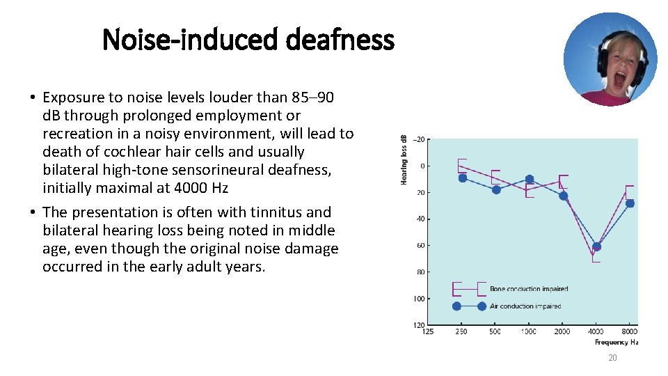 Noise-induced deafness • Exposure to noise levels louder than 85– 90 d. B through