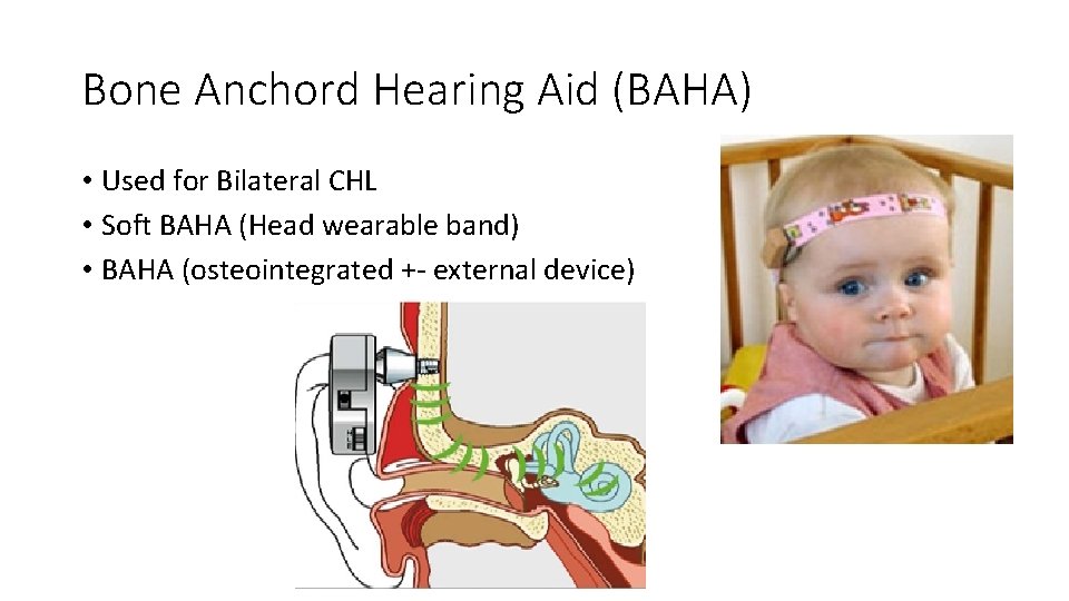 Bone Anchord Hearing Aid (BAHA) • Used for Bilateral CHL • Soft BAHA (Head