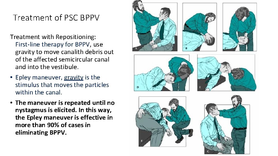 Treatment of PSC BPPV Treatment with Repositioning: First-line therapy for BPPV, use gravity to