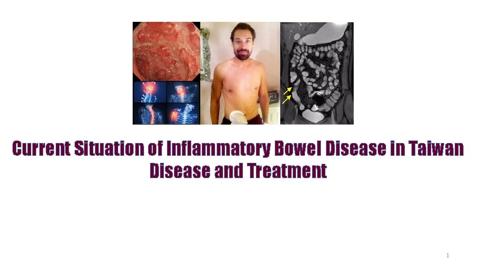 Current Situation of Inflammatory Bowel Disease in Taiwan Disease and Treatment 1 