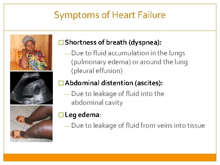 Symptoms of Heart Failure � Shortness of breath (dyspnea): — Due to fluid accumulation