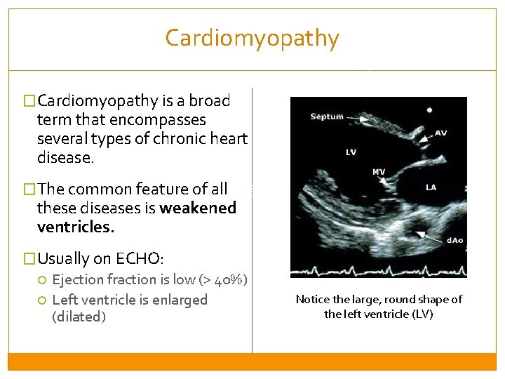 Cardiomyopathy �Cardiomyopathy is a broad term that encompasses several types of chronic heart disease.