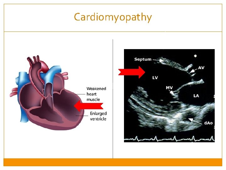 Cardiomyopathy 