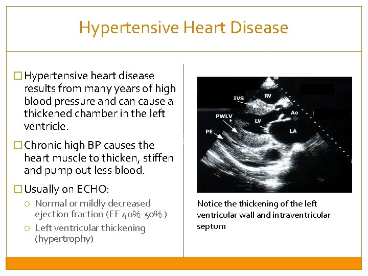 Hypertensive Heart Disease � Hypertensive heart disease results from many years of high blood