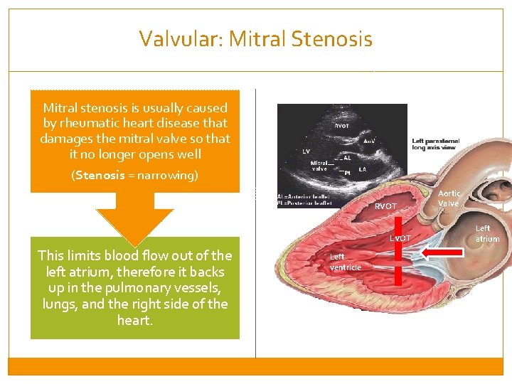 Valvular: Mitral Stenosis Mitral stenosis is usually caused by rheumatic heart disease that damages