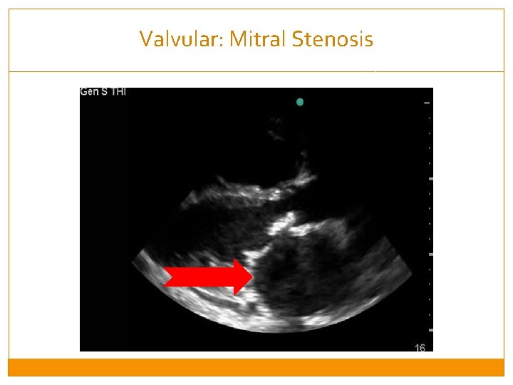 Valvular: Mitral Stenosis 