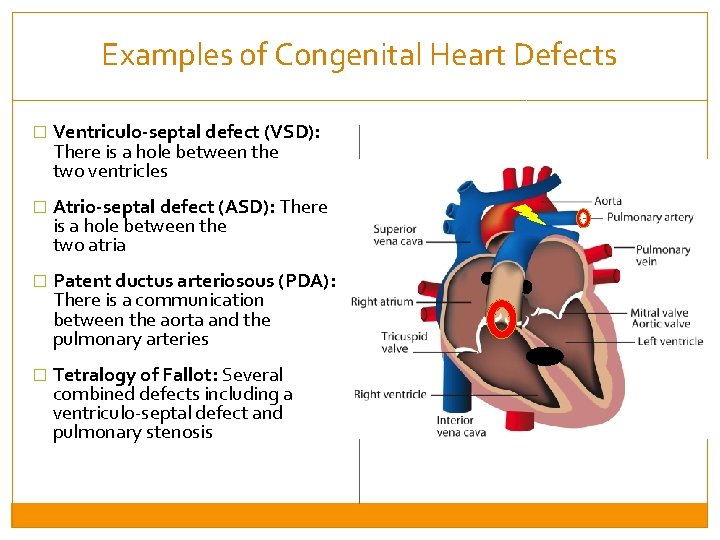 Examples of Congenital Heart Defects � Ventriculo-septal defect (VSD): There is a hole between