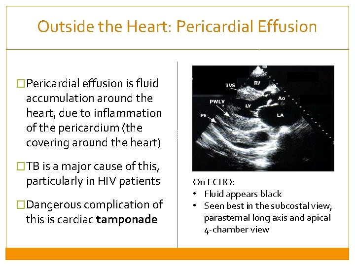 Outside the Heart: Pericardial Effusion �Pericardial effusion is fluid accumulation around the heart, due