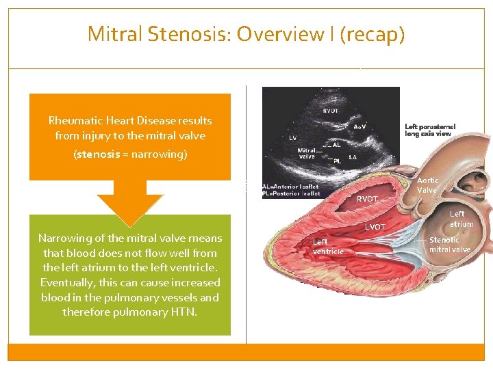 Mitral Stenosis: Overview I (recap) Rheumatic Heart Disease results from injury to the mitral