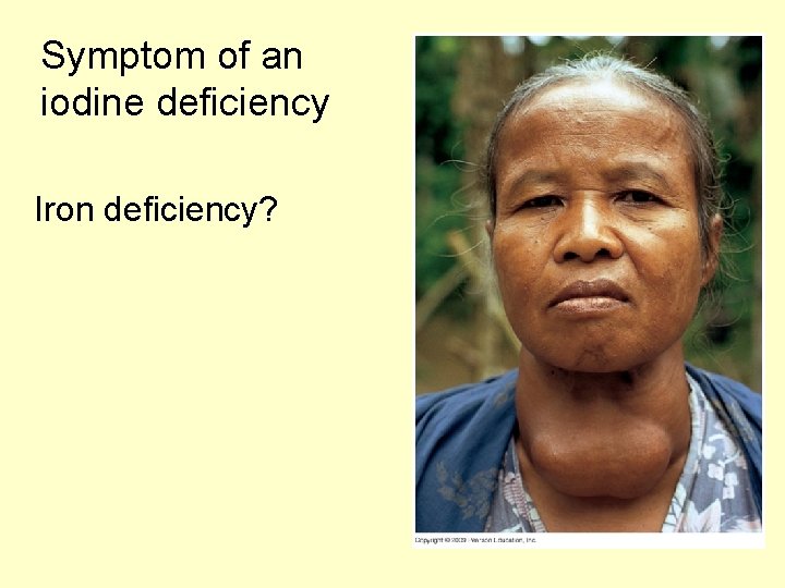 Symptom of an iodine deficiency Iron deficiency? 