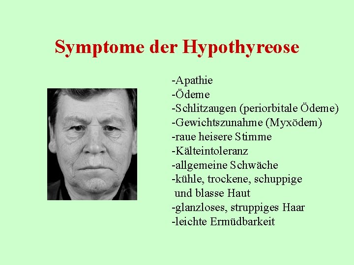 Symptome der Hypothyreose -Apathie -Ödeme -Schlitzaugen (periorbitale Ödeme) -Gewichtszunahme (Myxödem) -raue heisere Stimme -Kälteintoleranz