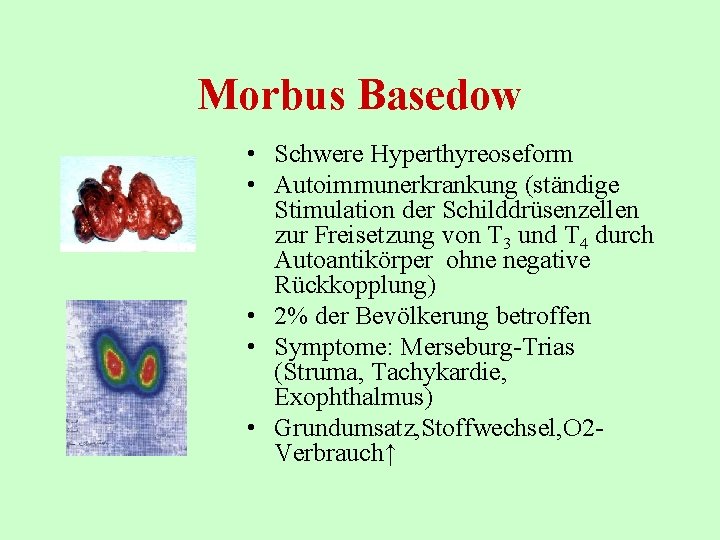 Morbus Basedow • Schwere Hyperthyreoseform • Autoimmunerkrankung (ständige Stimulation der Schilddrüsenzellen zur Freisetzung von