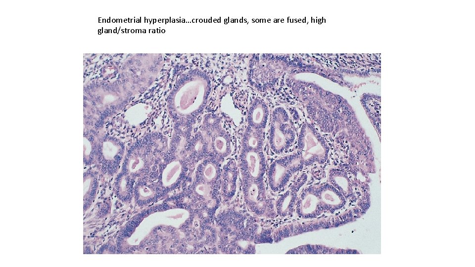 Endometrial hyperplasia…crouded glands, some are fused, high gland/stroma ratio 