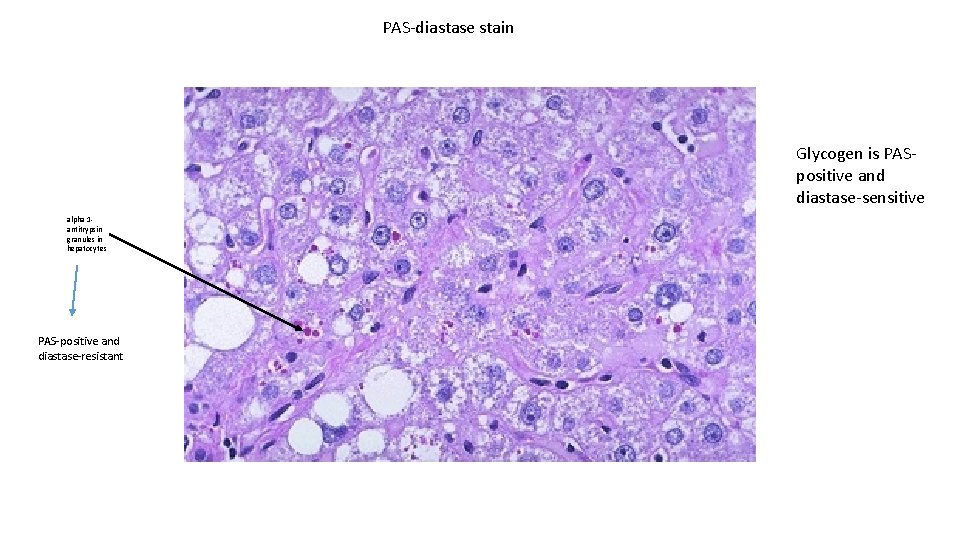 PAS-diastase stain Glycogen is PASpositive and diastase-sensitive alpha 1 antitrypsin granules in hepatocytes PAS-positive