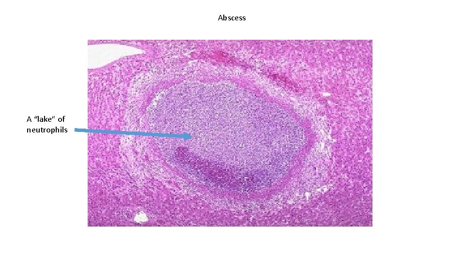 Abscess A “lake” of neutrophils 